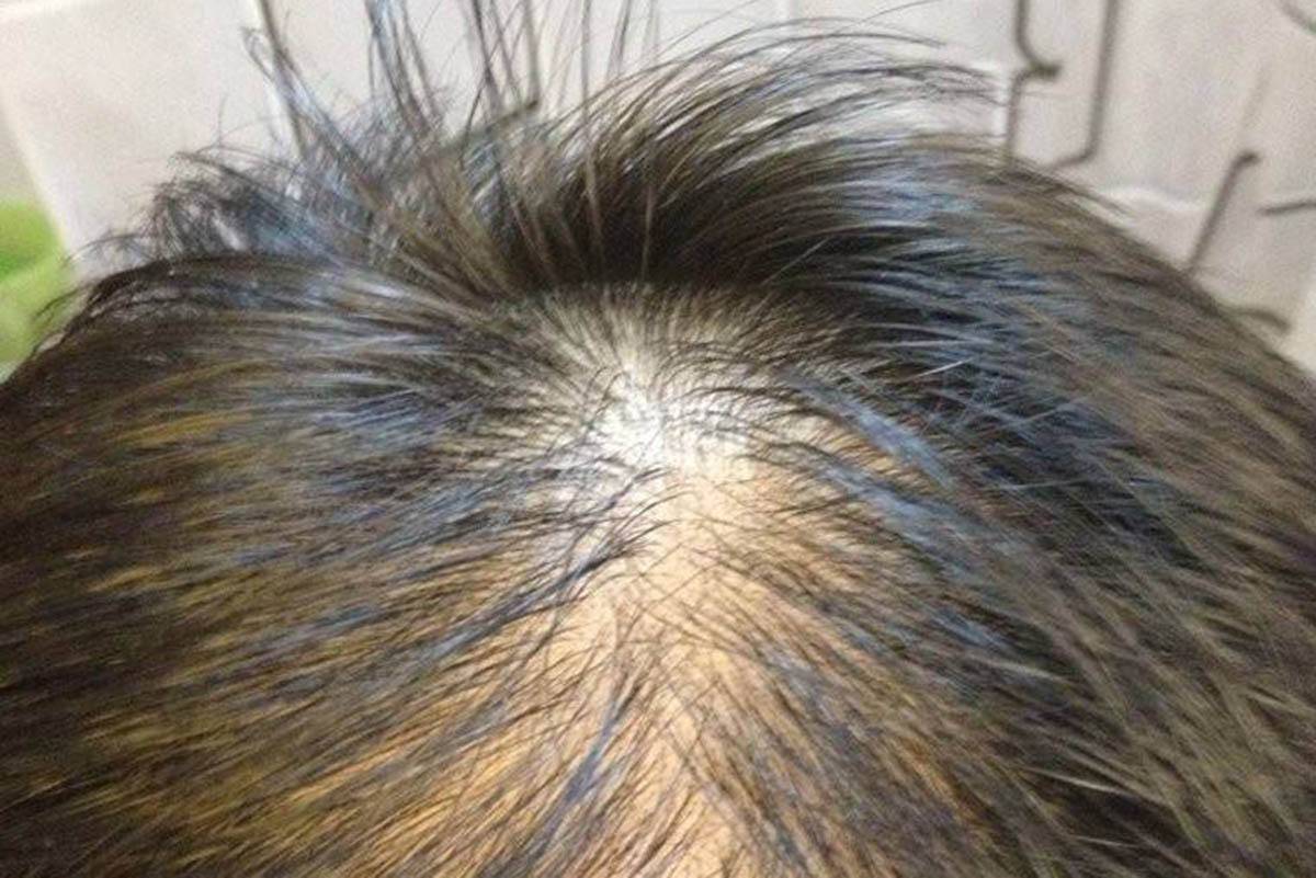 头顶上的头发少怎么办？脱发不能吃什么