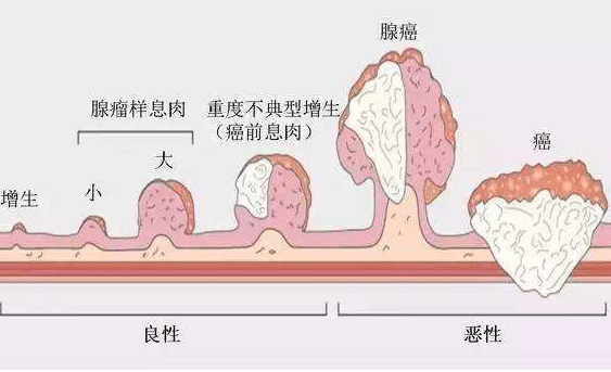 不要忽视小小的息肉 肠癌早期可能只是息肉