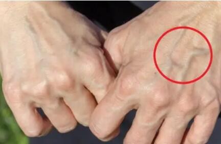 手上青筋暴起是怎么回事？快看看是不是这4种原因